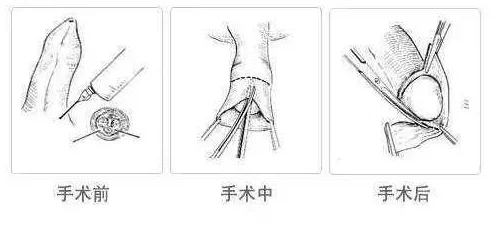 男人割了皮包什么样子要手举着呢术后恢复良好已拆线可轻度活动无需手举